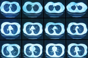 Can A Low-Dose CT Scan Detect Early-Stage Lung Cancer?