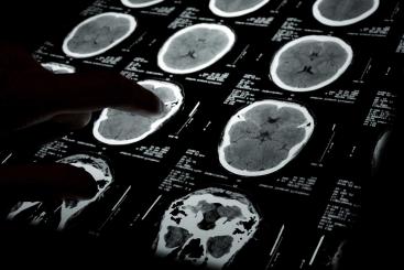 $29 Million Recovery In A Pediatric Brain Injury Case